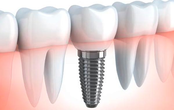 Implantes dentales en Benicàssim